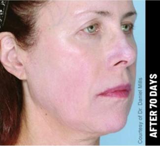 Ultherapy Before & After Patient #1550